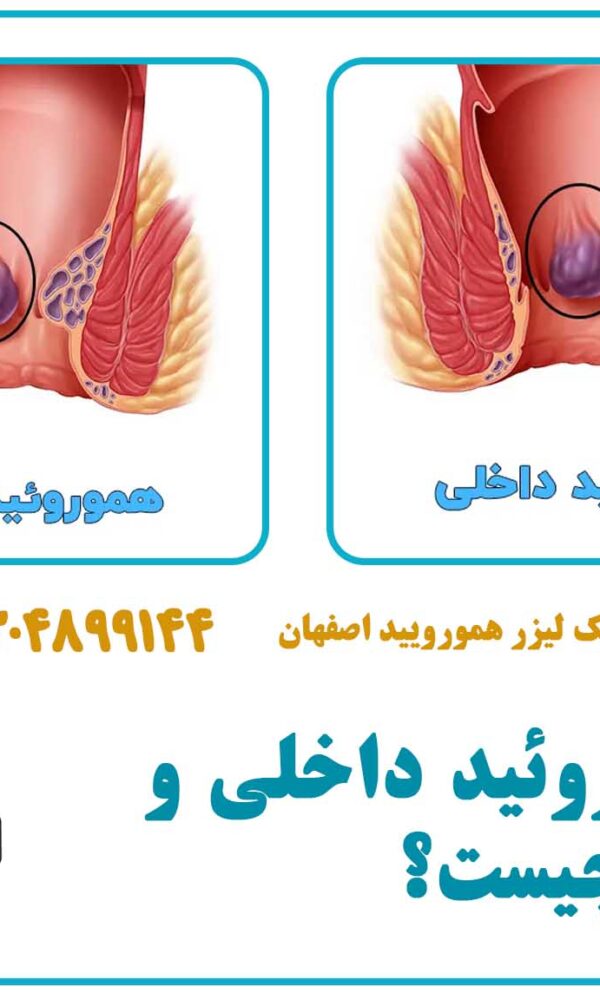 فرق هموروئید داخلی و خارجی چیست؟
