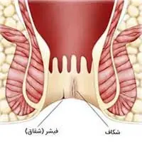 درمان فیشر در اصفهان