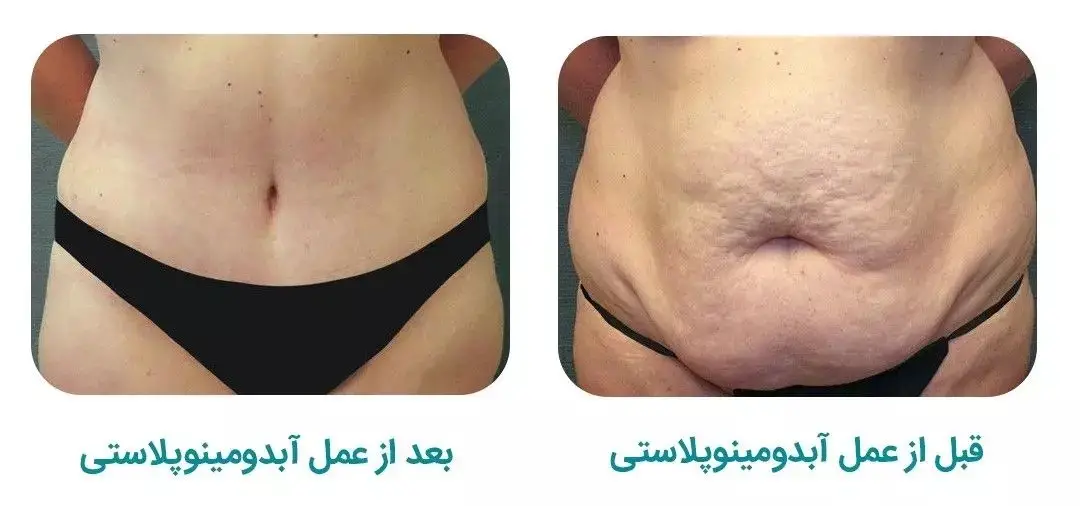 ابدومینوپلاستی