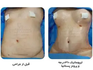 بهترین جراح ابدومینوپلاستی در اصفهان