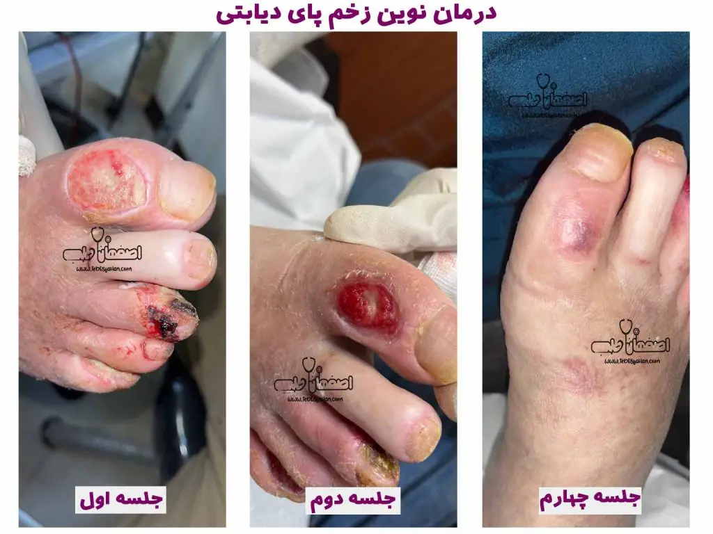درمان زخم پای دیابتی در اصفهان