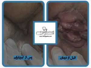 درمان هموروئید با لیزر در اصفهان