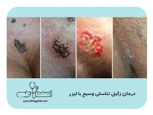Genital-Wart-Removal-in-Isfahan-Definitive-Treatment