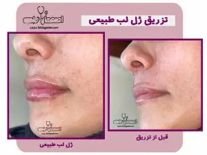 تزریق ژل 