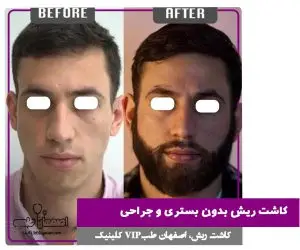 کاشت ریش اقساطی 