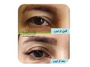 بلفاروپلاستی