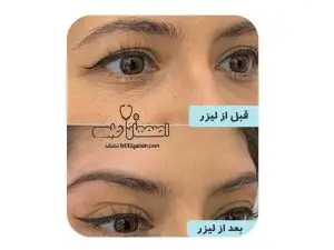 درمان افتادگی پلک با لیزر