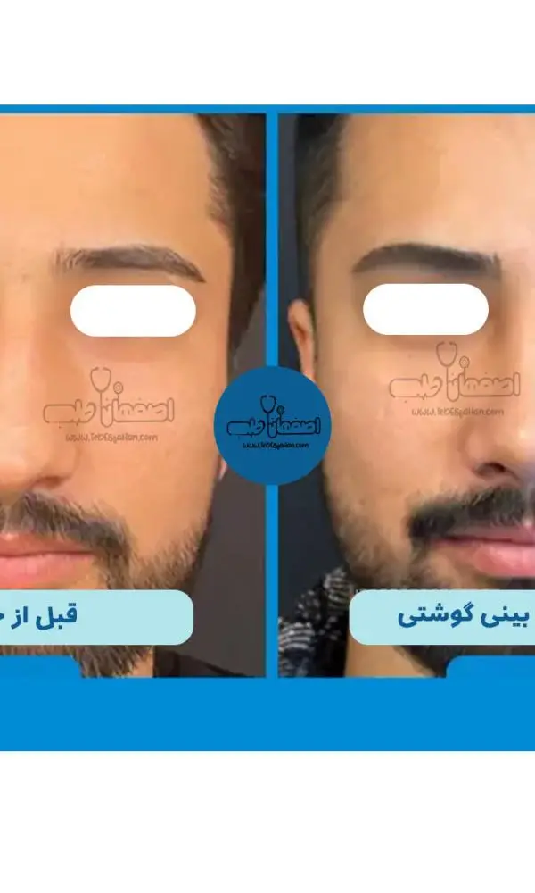 بهترین مرکز جراحی بینی گوشتی در اصفهان