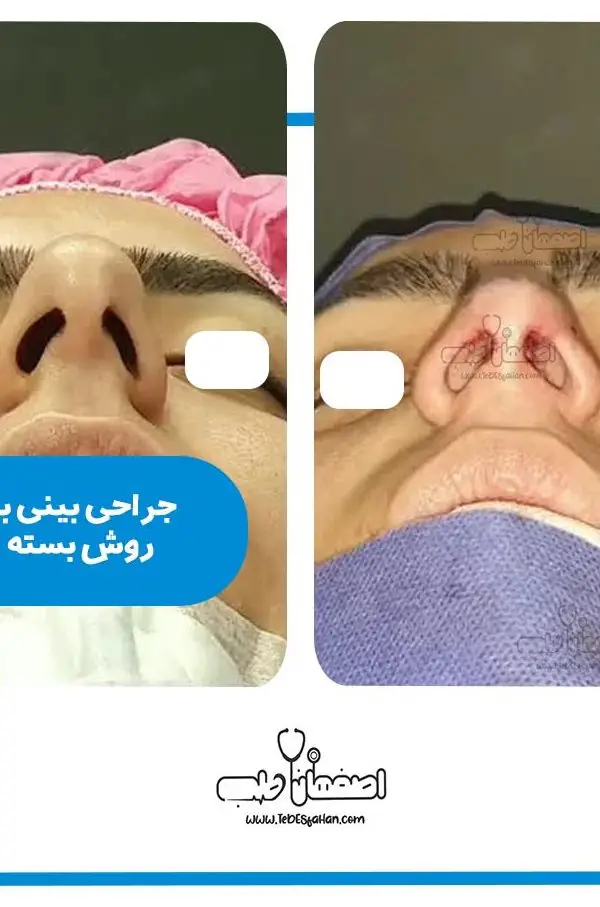 بهترین جراح بینی بسته در اصفهان