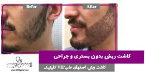 کاشت ریش اقساطی