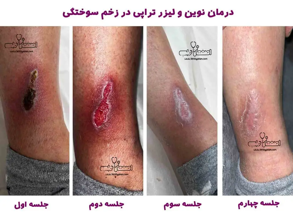 درمان سوختگی در اصفهان