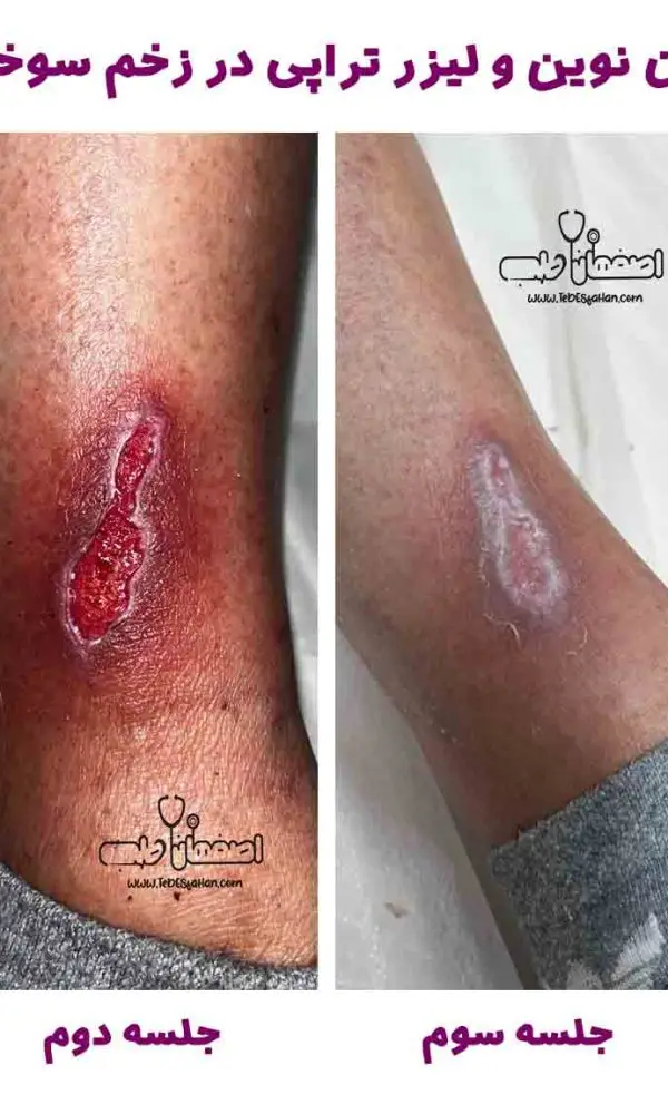 درمان سوختگی در اصفهان