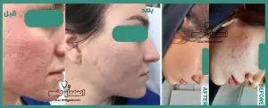 عکس قبل و بعد از لیزر جای زخم و جوش