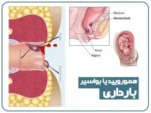 همورویید بارداری