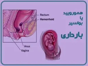 همورویید بارداری