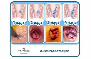 درجه بندی بواسیر