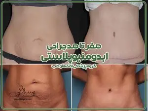 صفر تا صد ابدومینوپلاستی