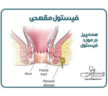 فیستول مقعدی چیست