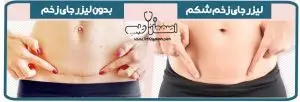 لیزر جای زخم شکم