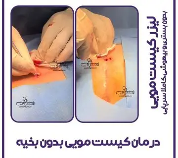 درمان سرپایی کیست مویی