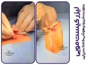 درمان کیست مویی بدون بخیه
