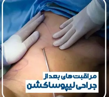 لیپوساکشن