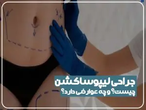 لیپوساکشن چیست