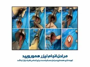 مراحل انجام لیزر همورویید