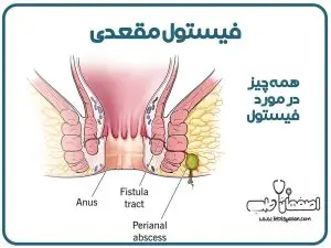 بیماری فیستول مقعدی