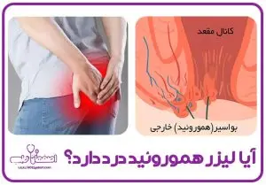 درد لیزر هموروئید