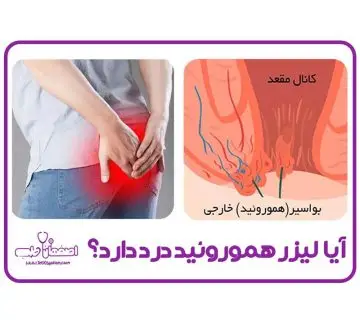 لیزر همورویید