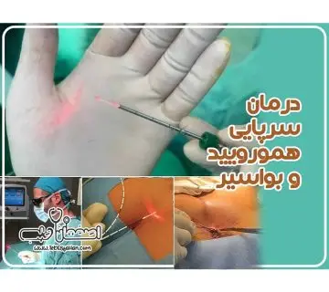 درمان سرپایی بواسیر