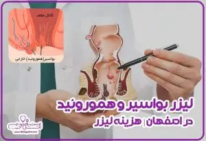 لیزر همورویید در اصفهان