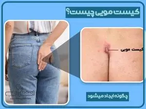 لیزر کیست مویی