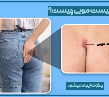 لیزر کیست مویی