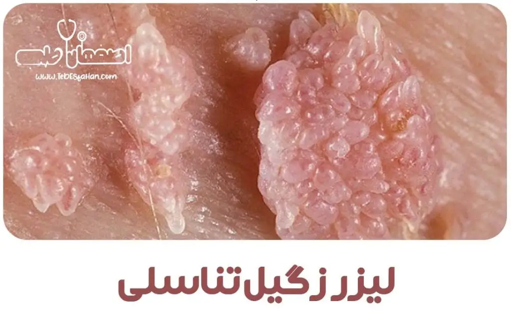 لیزر زگیل تناسلی