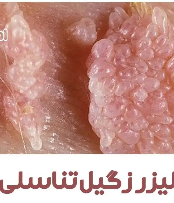 لیزر زگیل تناسلی