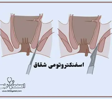اسفنکتروتومی چیست و چرا انجام می‌شود؟