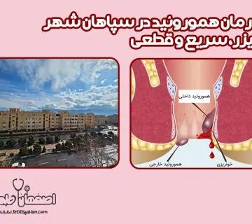 درمان هموروئید در سپاهان شهر لیزر، سریع‌ترین و مؤثرترین روش