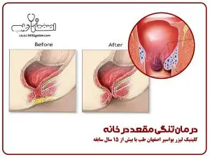 درمان تنگی مقعد در خانه: راهنمای کامل و علمی