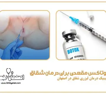 بوتاکس مقعدی برای درمان شقاق: درمان بدون جراحی و درد