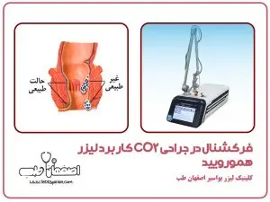 کاربرد لیزر CO2 فرکشنال در جراحی همورویید 
