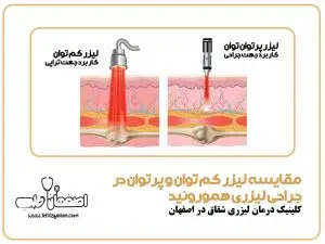مقایسه لیزر کم‌ توان و پرتوان در جراحی لیزری هموروئید