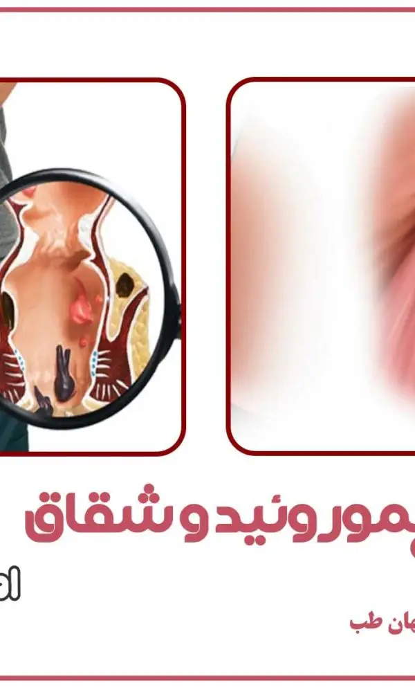 تفاوت هموروئید و شقاق چیست؟
