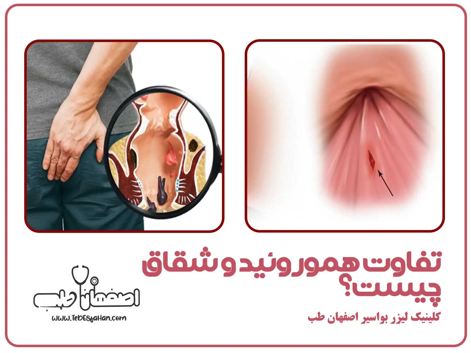 تفاوت هموروئید و شقاق چیست؟