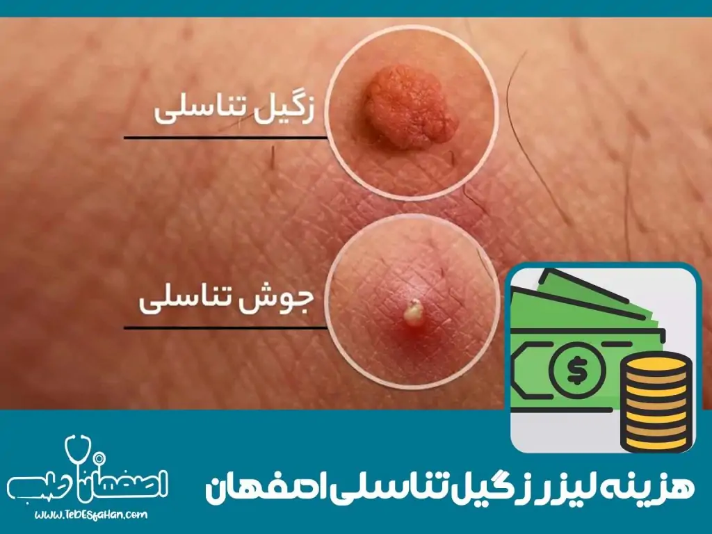 هزینه لیزر زگیل تناسلی در اصفهان