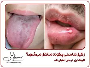 زگیل تناسلی چگونه منتقل میشود