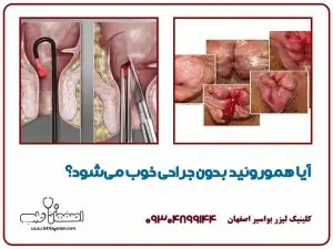 آیا هموروئید بدون جراحی خوب میشود؟