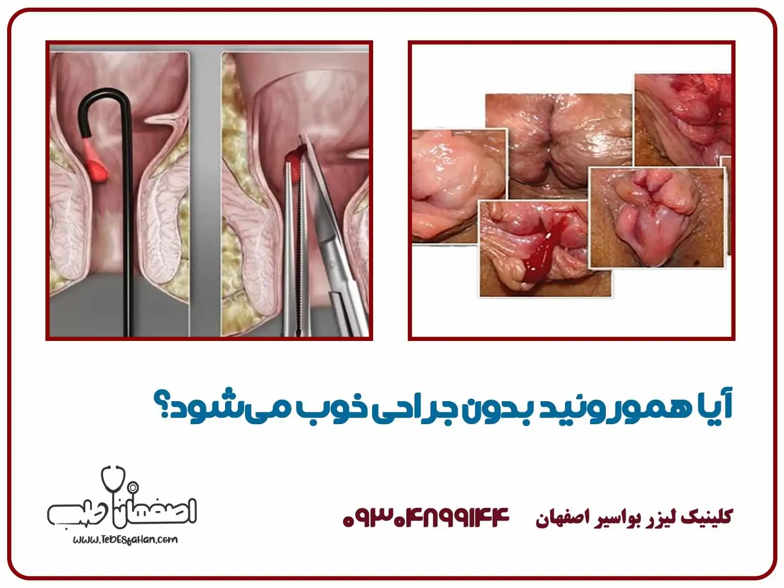 آیا هموروئید بدون جراحی خوب میشود؟