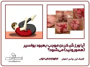 آیا ورزش کردن باعث بهبود بواسیر (هموروئید) می شود؟